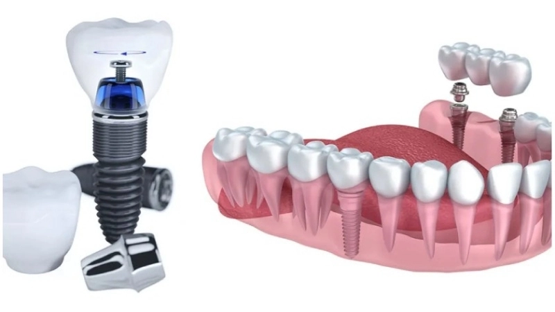 Ứng dụng nổi bật của công nghệ cấy ghép trong đời sống