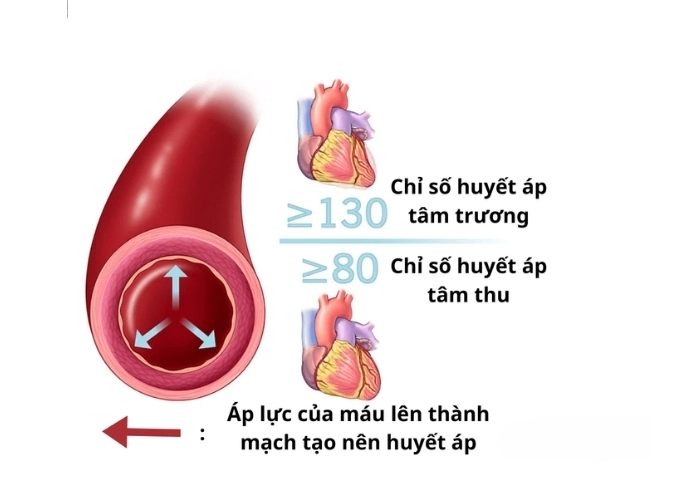 Giải mã huyết áp cao được gọi là gì rõ ràng