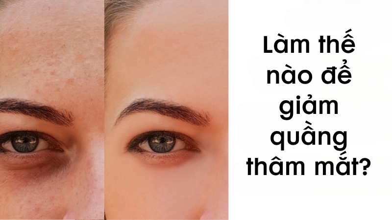 Làm thế nào để giảm quầng thâm mắt hiệu quả?
