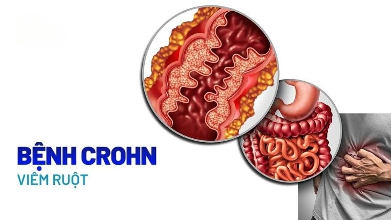 Bệnh Crohn là một loại bệnh viêm ruột mãn tính ảnh hưởng đến đường tiêu hóa