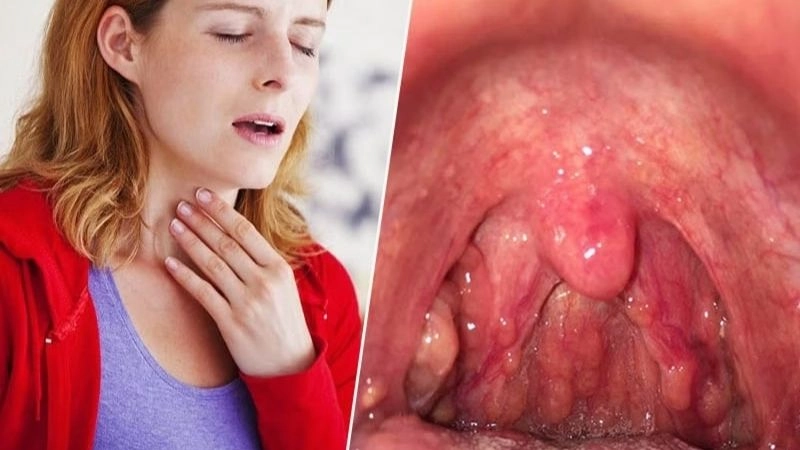 Viêm họng là một dạng bệnh viêm nhiễm trùng phổ biến gây đau cổ họng