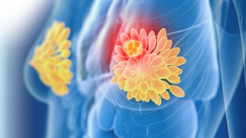 Những thay đổi về kích thước vú có thể là triệu chứng của bất kỳ loại ung thư vú nào