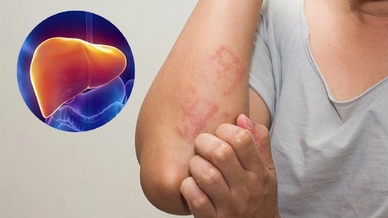 Viêm gan có khả năng cao gây ra dấu hiệu ngứa, mụn nhọt hoặc nổi mề đay
