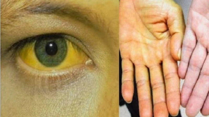 Vàng da là dấu hiệu điển hình của viêm gan
