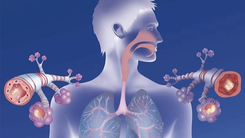 Hen suyễn (hen phế quản, tiếng Anh là Asthma) còn gọi là bệnh viêm niêm mạc phế quản mạn tính