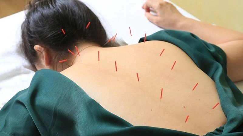 Cơn đau lưng mạn tính cũng có thể kiểm soát bằng biện pháp châm cứu