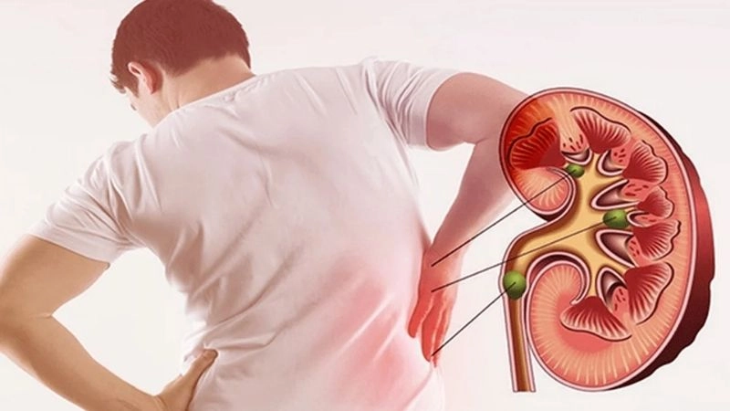 sỏi thận hoàn toàn là do biến chứng của viên sỏi gây ra với hệ tiết niệu