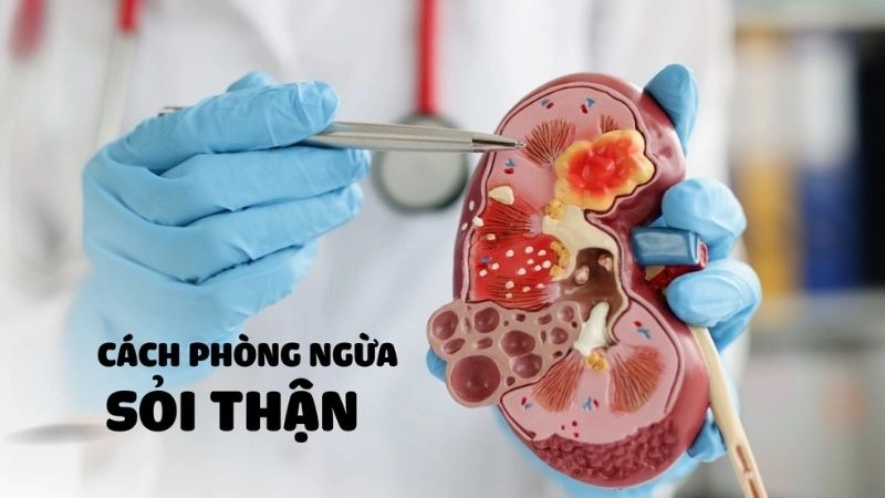 Cách hạn chế bị sỏi thận