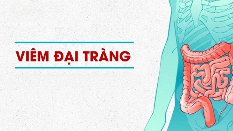 Viêm đại tràng là tình trạng viêm niêm mạc đại tràng