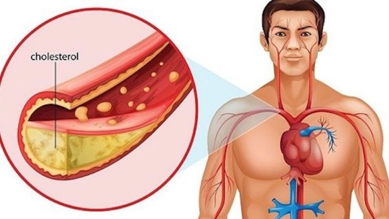 Cholesterol cao ảnh hưởng đến tim 