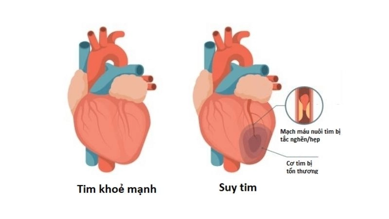 Các triệu chứng của bệnh tim do tăng huyết áp