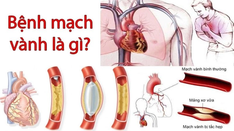 Bệnh động mạch vành là tình trạng khi các động mạch vành tải máu đến cơ tim bị hẹp hoặc cản trở do mảng bám
