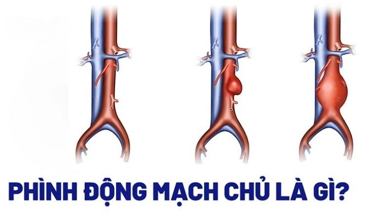 Phình động mạch chủ là tình trạng thành động mạch trở nên yếu đi và phình ra