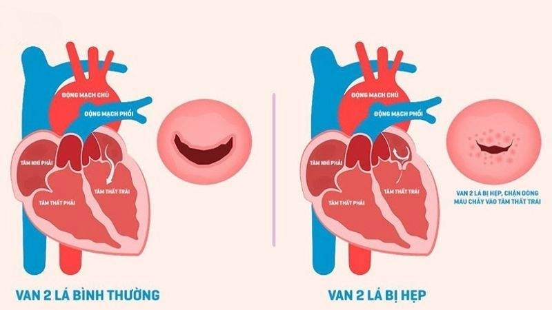 Bệnh van tim là tình trạng có thể xuất hiện ngay từ khi mới sinh
