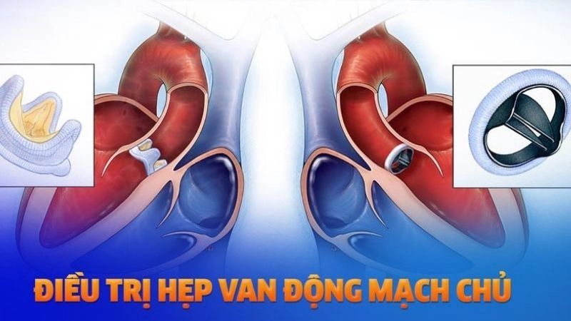 Với hẹp van đại động mạch, giờ đây, phương pháp điều trị ít xâm lấn 