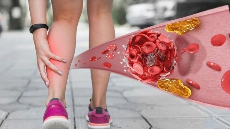 Nguyên nhân hay gặp của bệnh động mạch ngoại biên