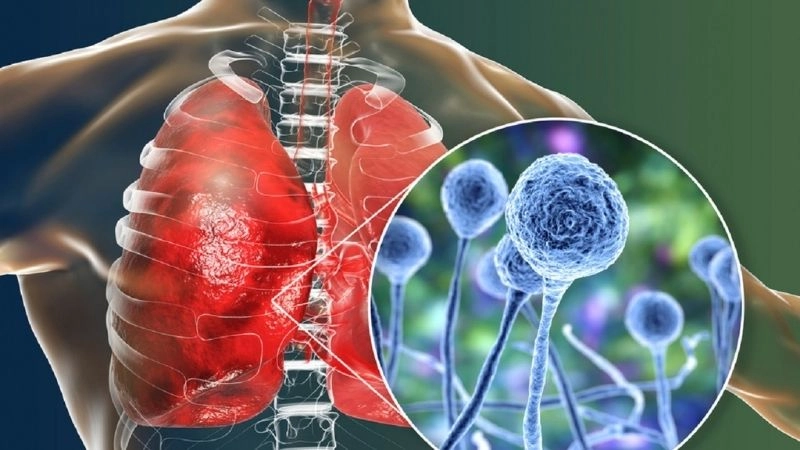 Các dấu hiệu và triệu chứng của bệnh viêm phổi 