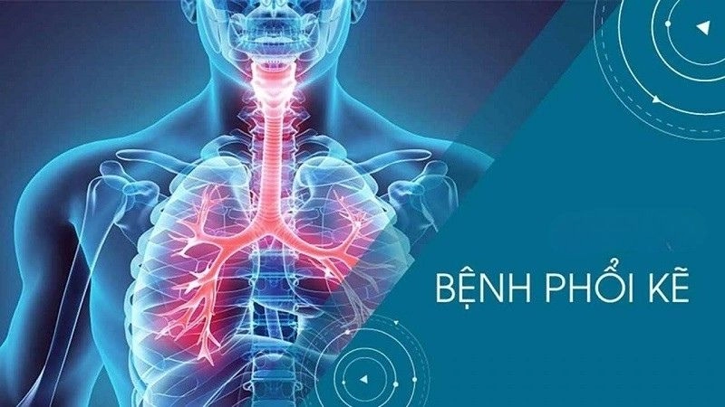 Bệnh phổi kẽ còn được gọi là bệnh nhu mô phổi lan tỏa