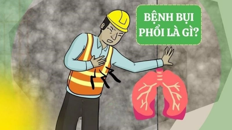 Bệnh bụi phổi (tiếng Anh là Pneumoconiosis) là một trong nhóm bệnh lý phổi kẽ