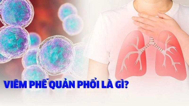 Viêm phế quản là tình trạng niêm mạc các ống phế quản (các ống dẫn không khí đến và đi ra từ phổi) bị sưng viêm