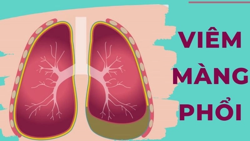 Viêm màng phổi là tình trạng lớp màng bao quanh phổi bị viêm và gây ra các cơn đau