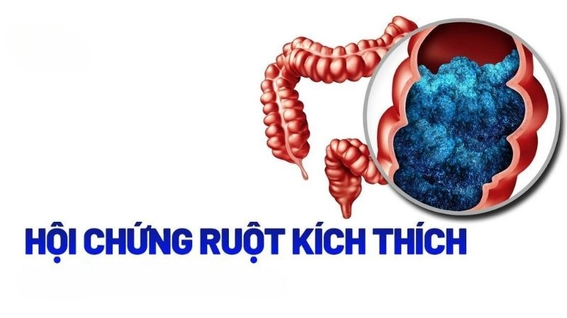 Hội chứng ruột kích thích (IBS) là rối loạn tiêu hóa mạn tính