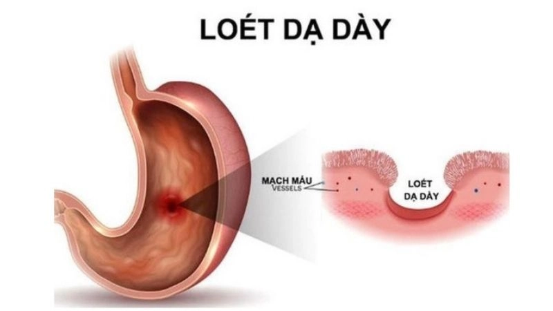 Viêm loét dạ dày là những tổn thương viêm và loét trên niêm mạc dạ dày