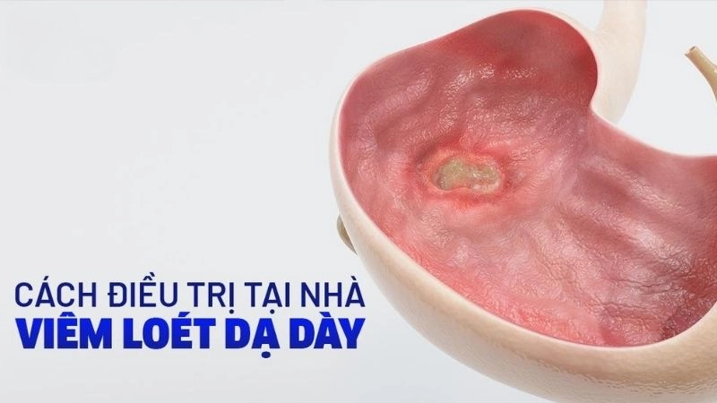  viêm loét dạ dày mạn tính kéo dài có thể dẫn đến những biến chứng nguy hiểm 