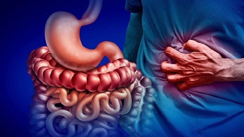 Crohn là bệnh viêm mạn tính mô hạt của đường ống tiêu hóa