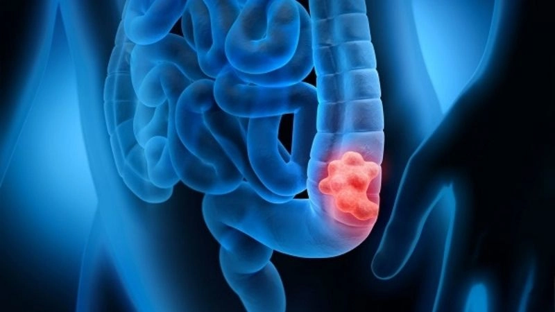 Ung thư đại tràng (colon cancer) là ung thư phổ biến ở cả nam và nữ