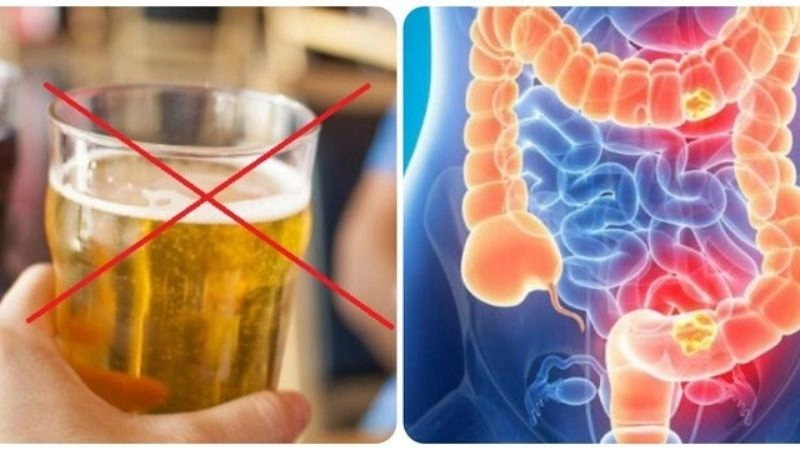 Cách phòng ngừa ung thư đại tràng