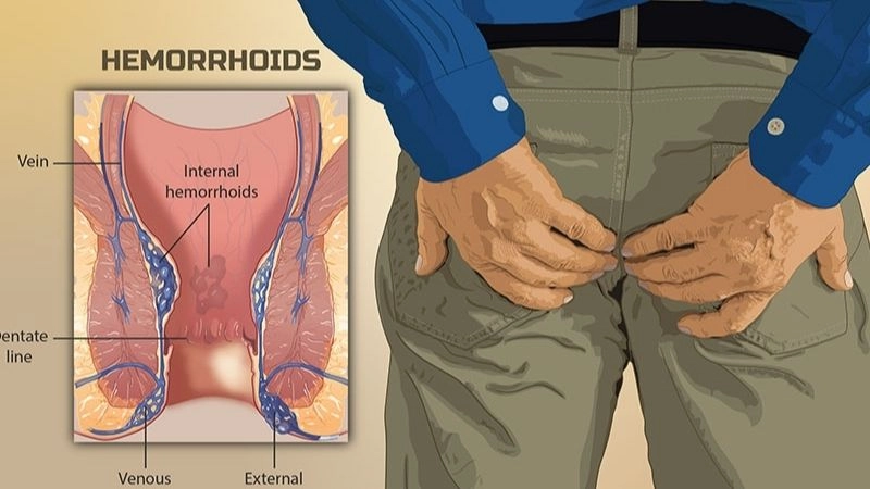 Nguyên nhân bệnh trĩ hay gặp ở người lớn tuổi