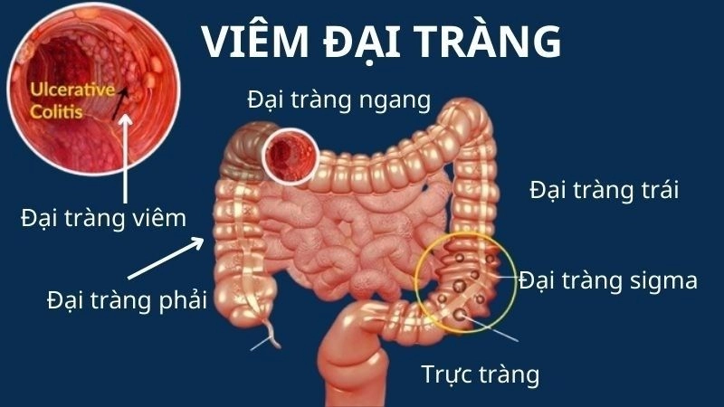 Viêm loét đại tràng là một bệnh viêm ruột 