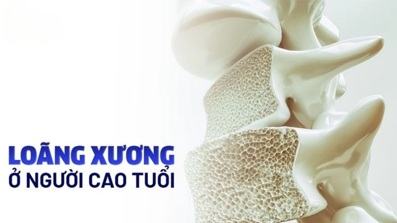 Loãng xương ở người cao tuổi là một bệnh lý thường gặp 