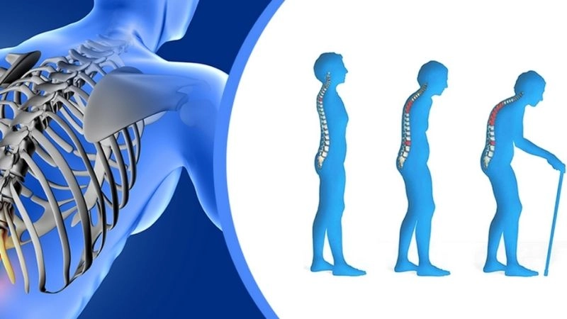 Dấu hiệu nhận biết bệnh loãng xương ở người cao tuổi
