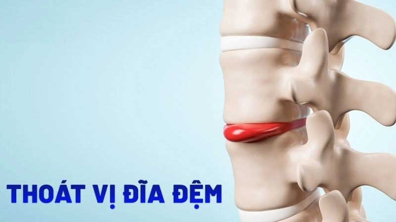 Bệnh thoát vị đĩa đệm được chia làm 4 giai đoạn