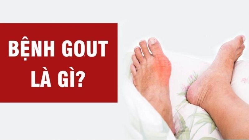 Gout (gút) là một dạng của viêm khớp, xảy ra khi có nhiều acid uric trong máu