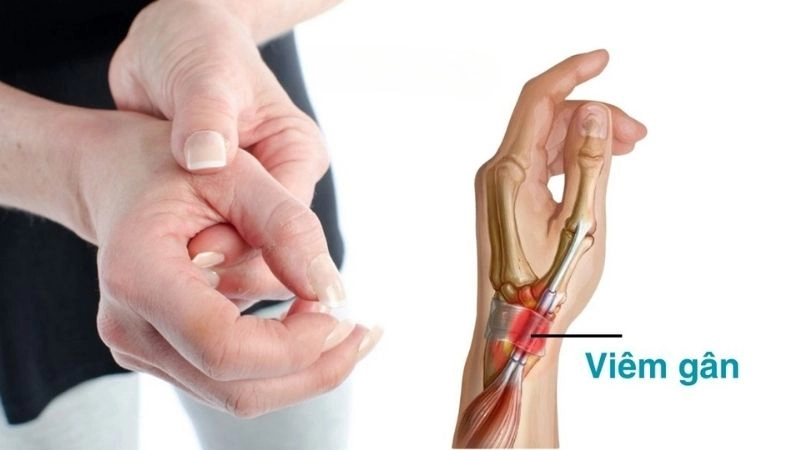 Viêm gân là tình trạng gân bị viêm hay tổn thương