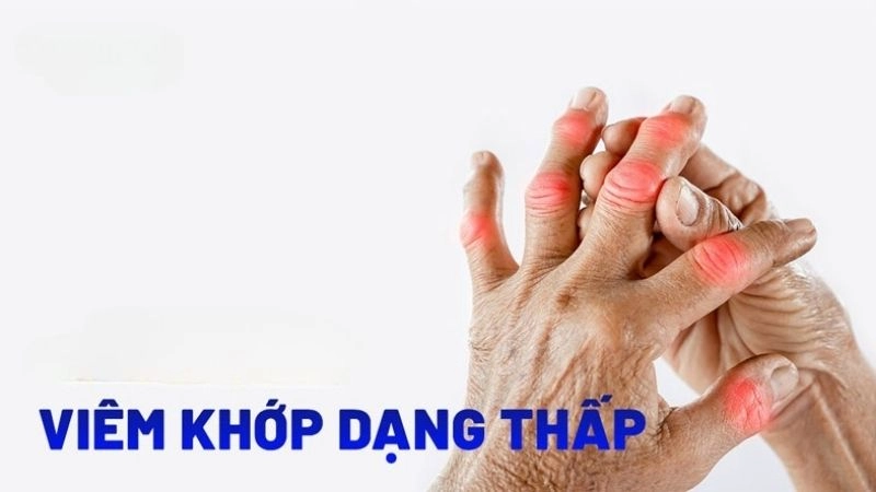 Viêm khớp dạng thấp (RA – Rheumatoid Arthritis) là bệnh lý viêm khớp tự miễn mạn tính