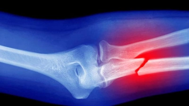 Gãy xương là tình trạng xương bị biến dạng