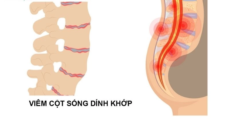 Viêm cột sống dính khớp khiến một số đốt sống dính lại với nhau