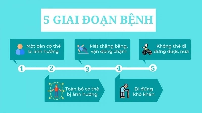 Parkinson được chia làm 5 giai đoạn tiến triển chính