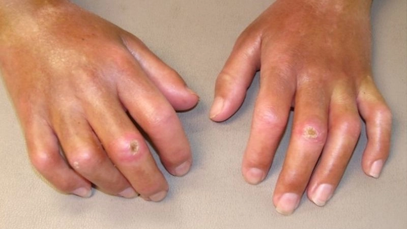 Các triệu chứng bệnh đa xơ cứng xảy ra tùy thuộc vào dây thần kinh