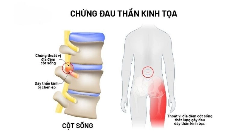 Đau thần kinh tọa là cơn đau xảy ra do chấn thương hoặc kích thích dây thần kinh hông to 