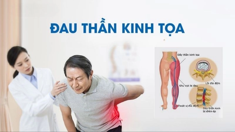 triệu chứng đau thần kinh tọa nghiêm trọng người bệnh cần liên hệ ngay với bác sĩ
