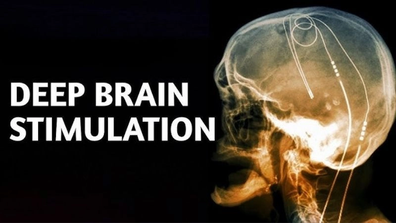 Liệu pháp kích thích não sâu hoạt động như thế nào?