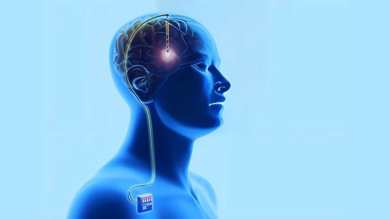 Kích thích não sâu được đặt trên đầu của người bệnh