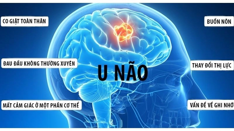 Những triệu chứng đầu tiên cảnh báo bệnh u não nguy hiểm