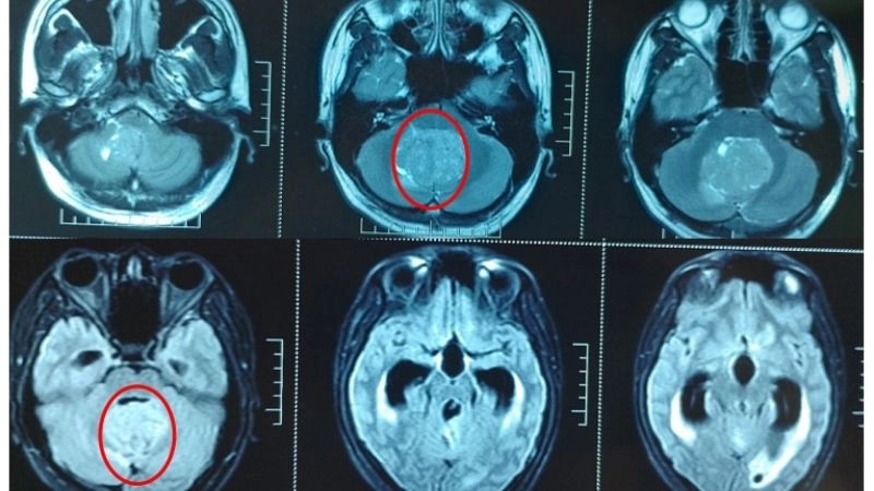 U não sẽ được phát hiện thông qua các triệu chứng được ghi nhận 