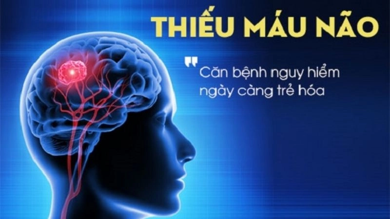 Thiếu máu não là tình trạng giảm lưu thông máu lên não
